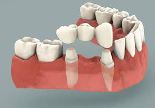 Dental Bridges