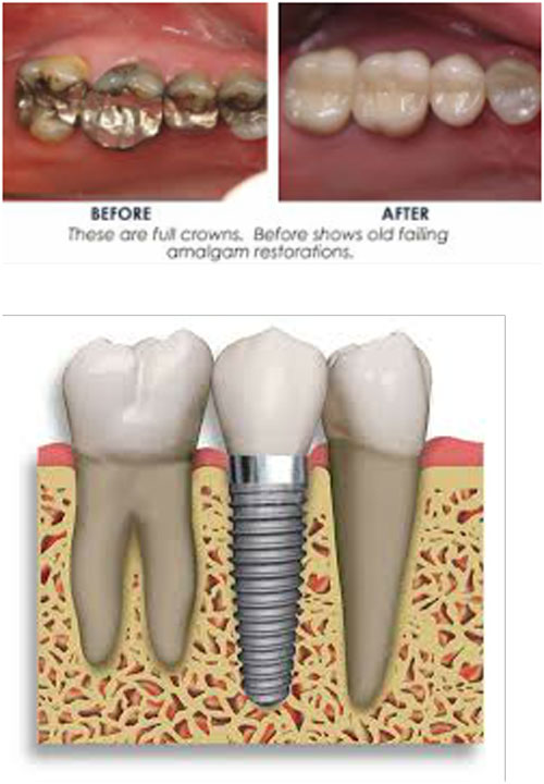 Dental Crowns