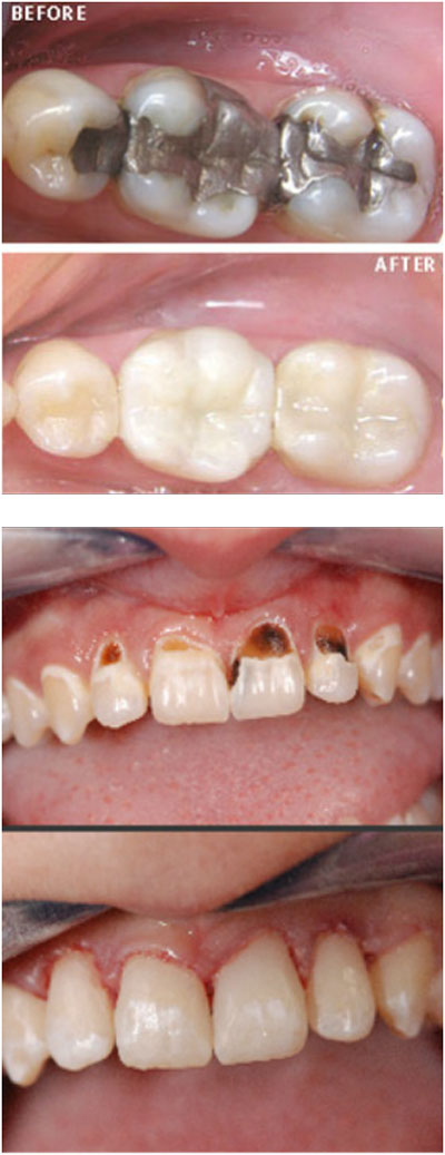 Replacing Amalgam fillings