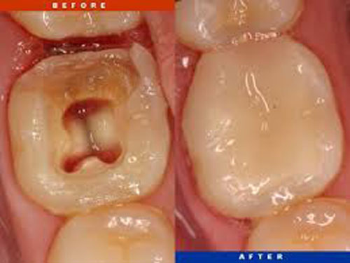 Root-Canal-Before-After