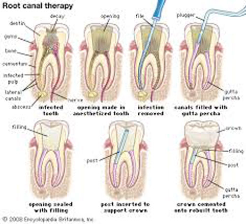 Root Canal Treatment