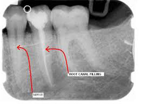 Root-Canal-Xray