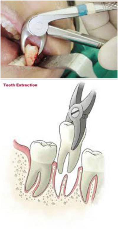 Teeth Extractions